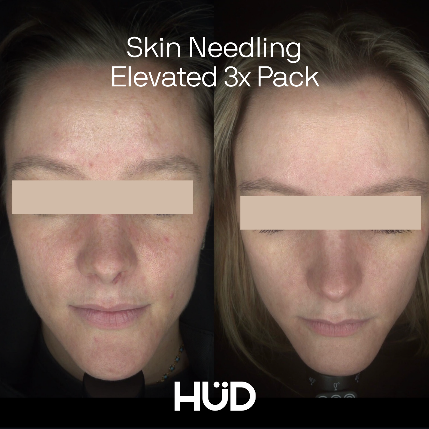 Skin Needling Elevated 3x Pack | April Special 🤍 Save $440