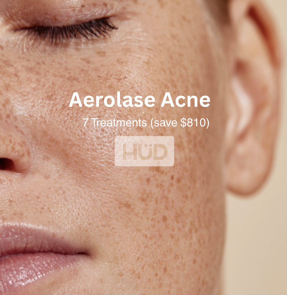 Aerolase Acne Series (7 treatments)  SAVE $810 -  Zip Pay and Afterpay Available
